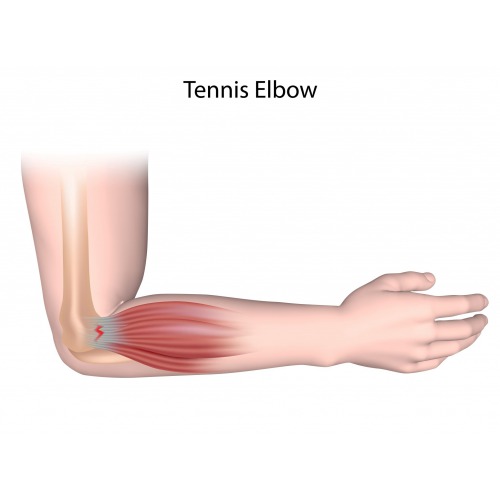 https://www.sunshinephysiotherapy.com/Case Study :Tennis Elbow  Pain Relief 